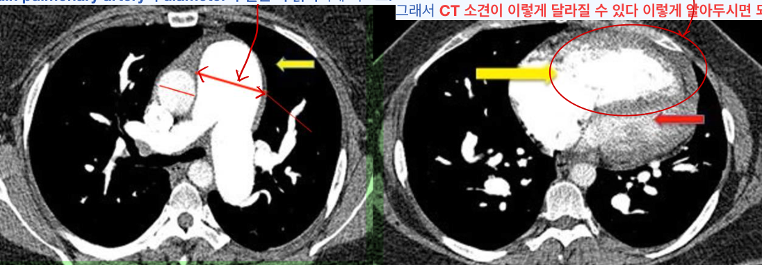 CTEPH 조영증강 CT — main PA가 대동맥보다 굵고 우심실이 확장·비대된 폐고혈압 소견.