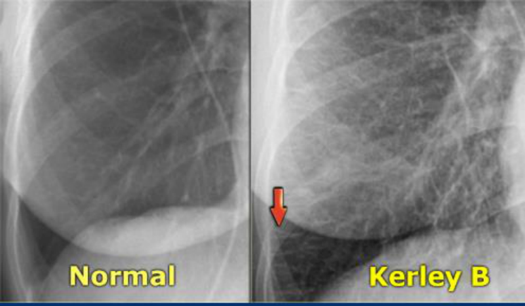 폐부종 흉부 X-ray — 심비대, hilum 중심 대칭적 bat-wing 음영, Kerley B lines.