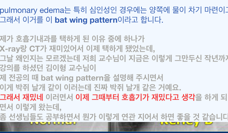 폐부종 흉부 X-ray — hilum 중심 대칭 bat-wing 음영(편측 pneumonia와 감별).