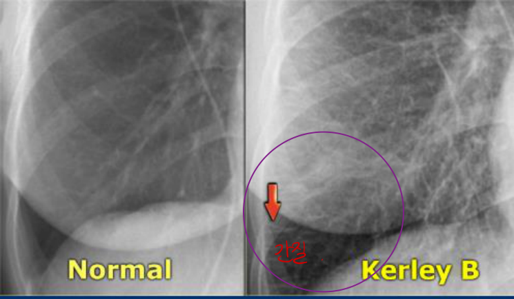 Kerley B line(X-ray)과 CT 소엽간 중격비후의 영상 대응.