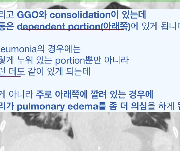 폐부종 CT — dependent 부위 우세 GGO/consolidation과 중격비후.