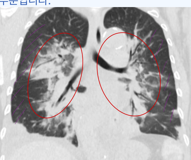 폐부종 CT — perihilar 분포 + 말초 sparing(peripheral 정상).