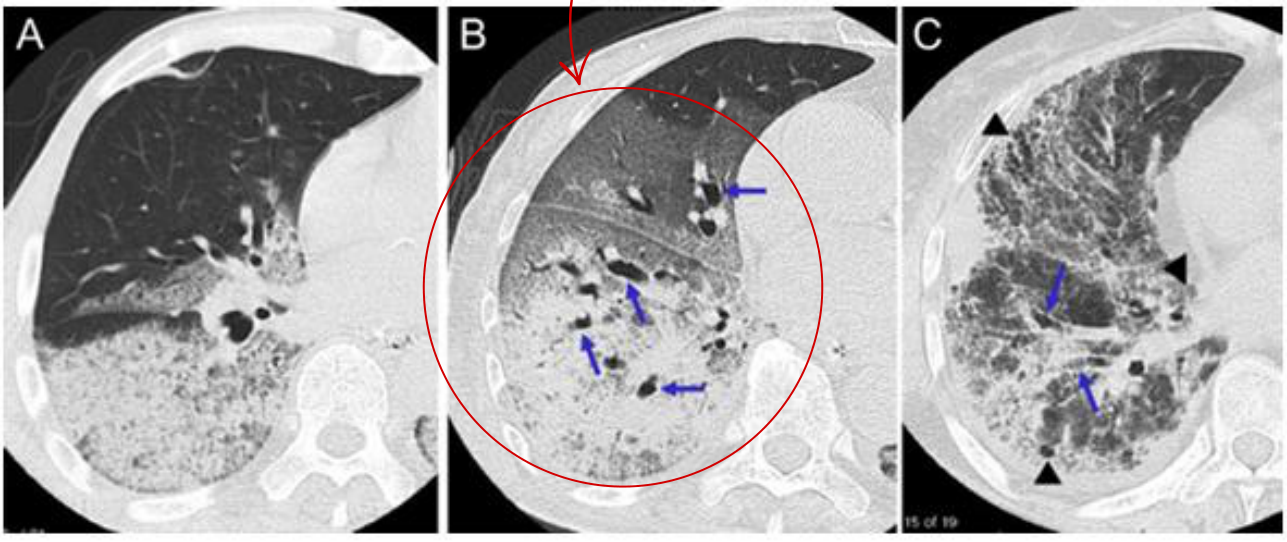 3 Phase HRCT(Exudative/Proliferative/Fibrotic) — ARDS와 폐부종의 분포 차이 비교(BMJ Open 2012).