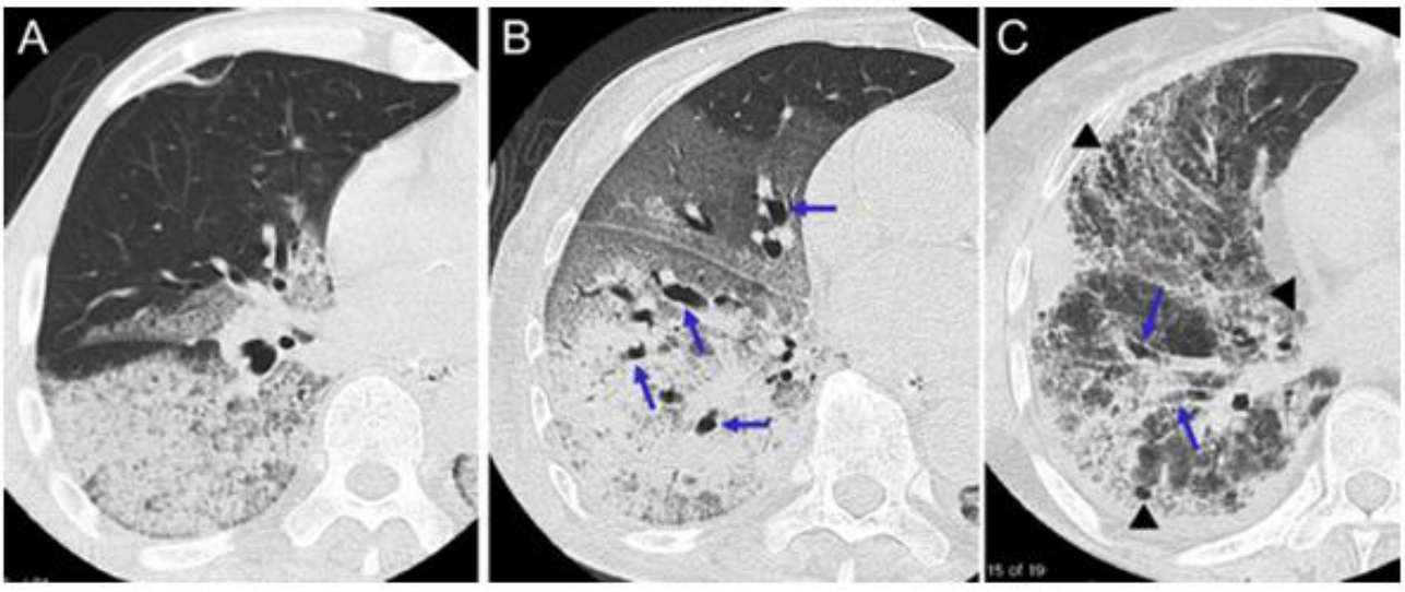 ARDS 3 Phase HRCT(A/B/C) — exudative→proliferative→fibrotic 진행(42p와 동일 슬라이드).