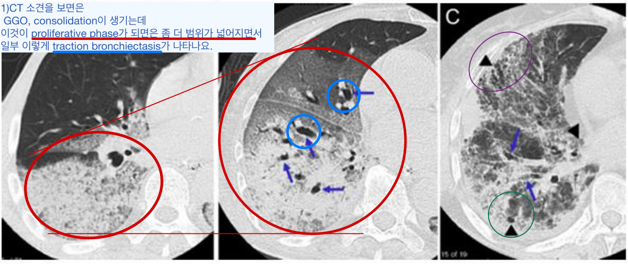 ARDS HRCT phase B — 광범위 consolidation/GGO에 traction bronchiectasis 동반.