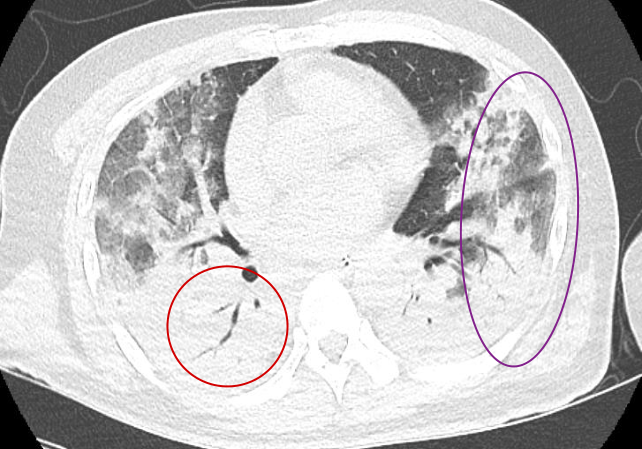 ARDS 케이스 흉부 CT — 양측 peribronchial GGO/consolidation에 air-bronchogram 동반.