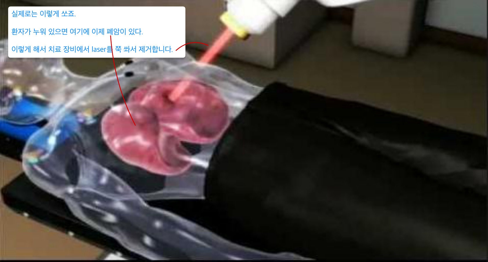 환자 위 치료 장비 빔 조사 — 폐 종양 타격 도해