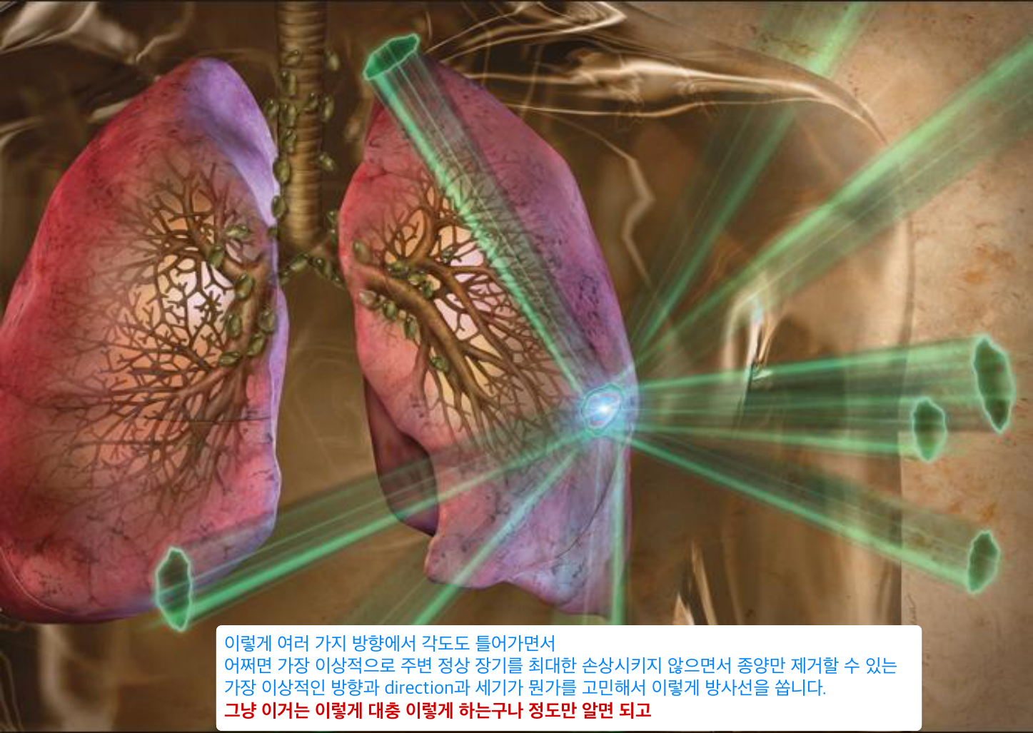 다각도 conformal 조사 — 종양에 빔 수렴, 정상 폐 보존