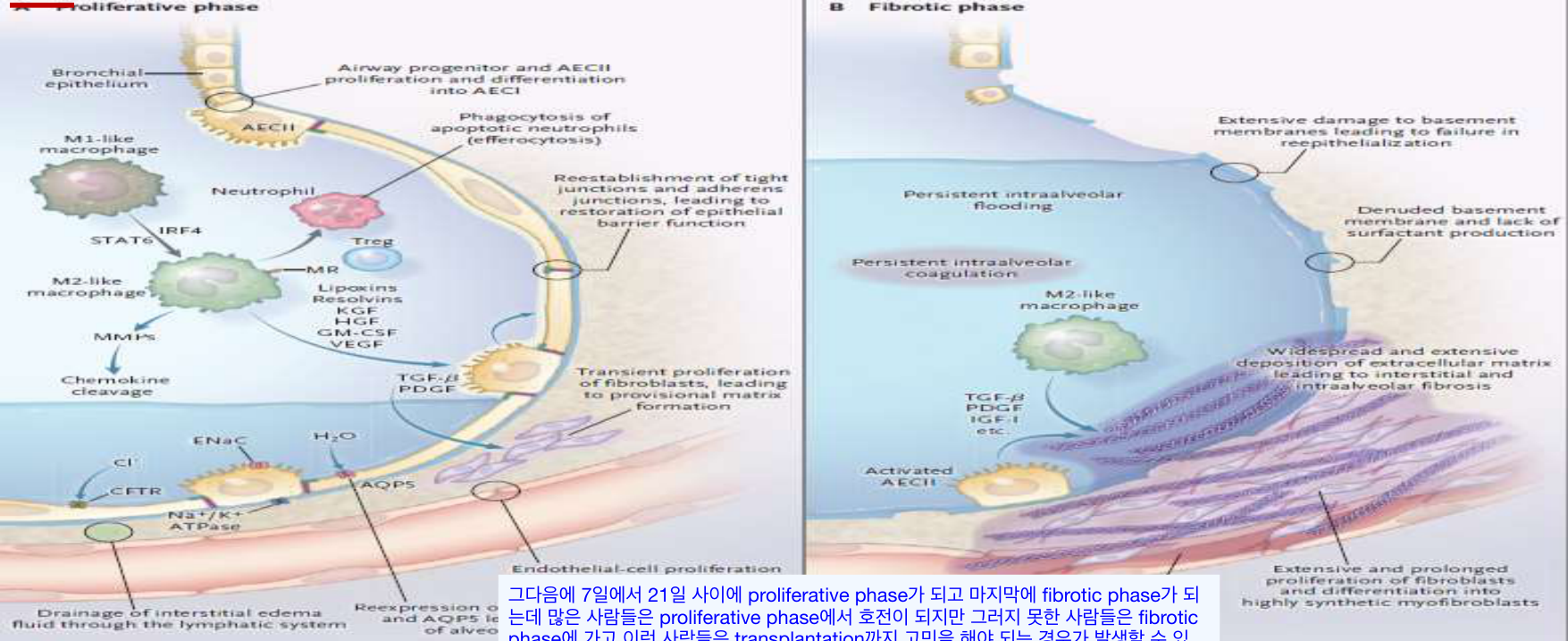 Proliferative/fibrotic phase 모식도 (NEJM 2017)