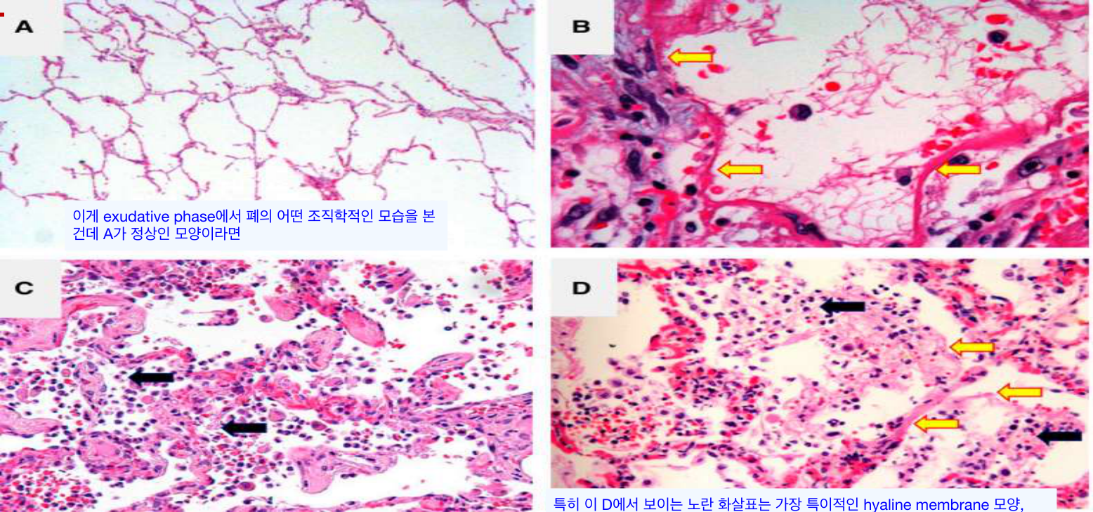 ARDS exudative phase 병리: DAD·hyaline membrane (A-D)