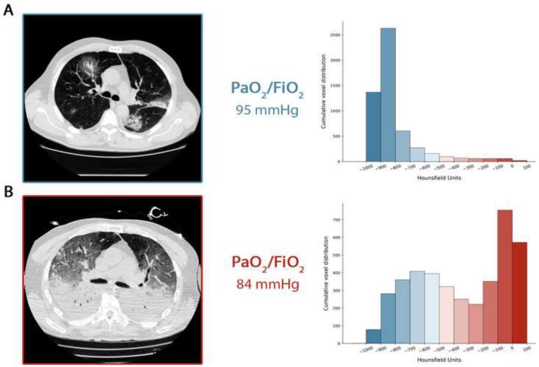 Type H vs Type L ARDS CT 및 정량 (Intensive Care Med 2020)