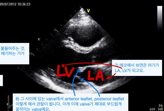 경흉부 심초음파 (parasternal long-axis, 2D 흑백) — 좌심방·좌심실과 그 사이 승모판엽(mitral leaflet)의 개폐를 보는 기본 단면.