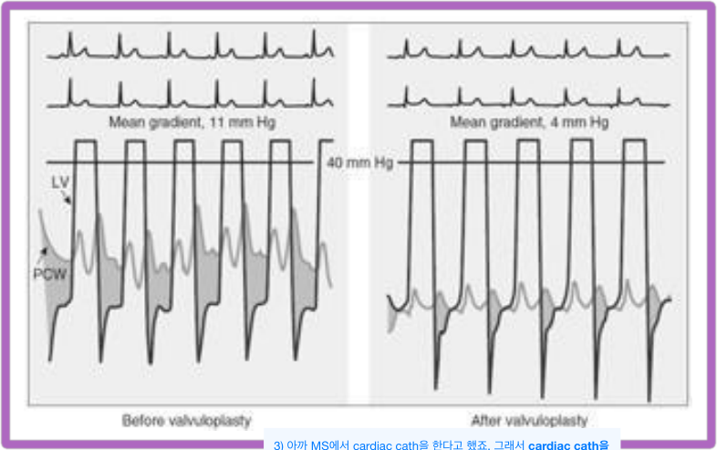 심도자(cardiac cath) 동시압력 곡선 — PMBV(경피적 승모판 풍선판막성형술) 전후 비교. 상단 ECG, 하단 LV압과 PCW압(≈LA압) 중첩 곡선이며 둘 사이 회색 음영 면적 = 확장기 압력차. 시술 전(Before valvuloplasty) mean gradient 11 mmHg → 시술 후(After valvuloplasty) 4 mmHg로 감소(40 mmHg 기준선 표시)하여 판막 면적 확대를 직접 확인.