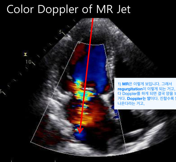 경흉부 심초음파 — color Doppler상 LA로 향하는 승모판 역류 jet, 모자이크(파랑+빨강) 패턴이 난류성 MR을 시사.